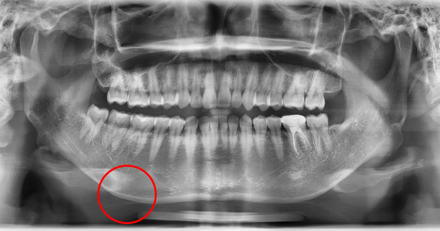 Jaw Contour Surgery: Why Is Revision Surgery Performed? image 2