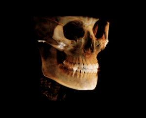 After Facial Contouring Surgery: Asymmetry, When Can Revision Surgery Be Performed? image 2
