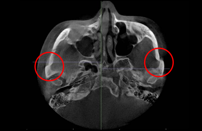 Will cheekbone reduction surgery also make the face smaller? : Learn about how to reduce prominent cheekbones with real surgical cases image 6