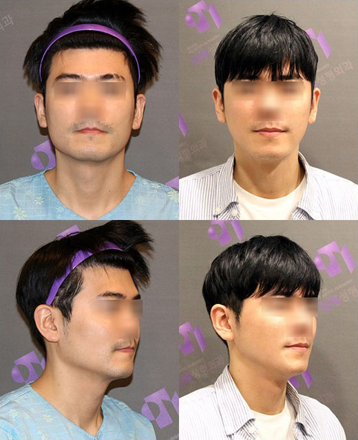남자사각턱수술이 여자와 다른 이유는? 관련 이미지 5