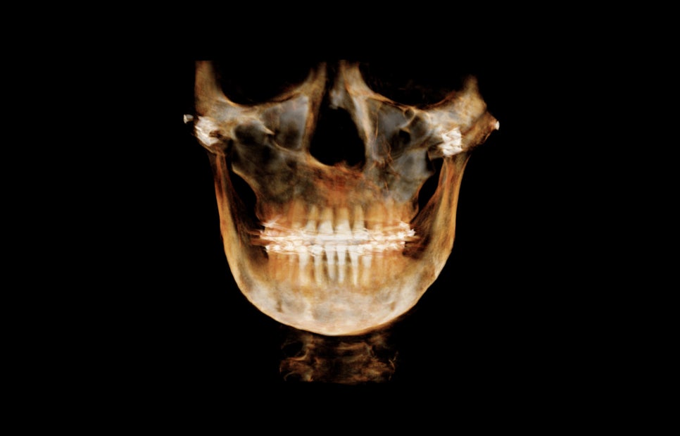 Is It Necessary to Remove the Fixation Pins After Facial Contouring Surgery? image 9