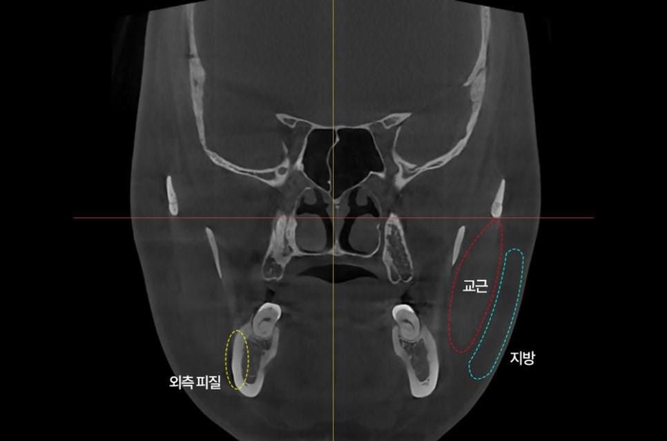 사각턱 유형에 따라 수술 효과가 달라진다? 말린 턱과 뻗친 턱의 차이 관련 이미지 6