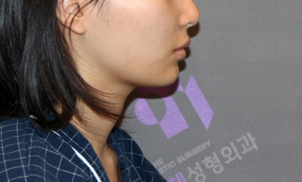 [Chin Surgery] Learning About Contouring Shaving and T-Osteotomy with Real Patient Cases (3) image 14