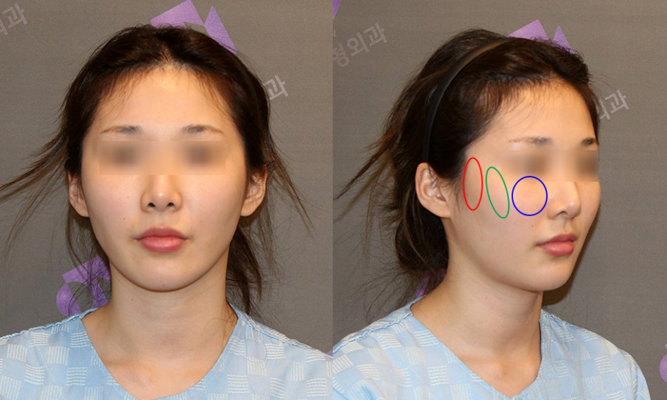 Does the Surgical Method Change Depending on the Protruding Cheekbone Location? Exact Locations and Diagnosis of the Front Cheekbone, Side Cheekbone, 45-Degree Cheekbone, and Back Cheekbone image 2