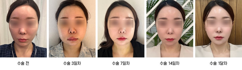 What uncomfortable symptoms can occur after chin surgery? image 6