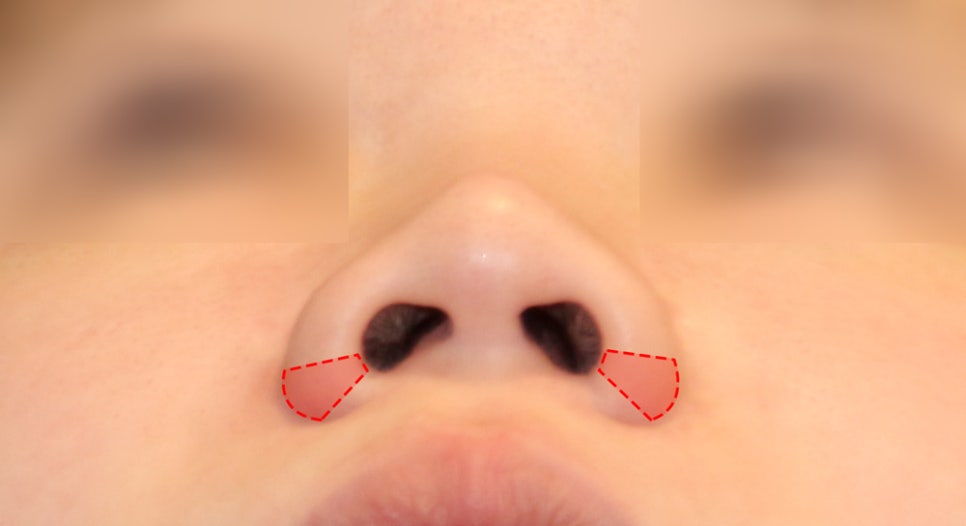 Incisional or Non-incisional? A Review of Alar Reduction Surgery Cases (Alar Base Reduction) image 1