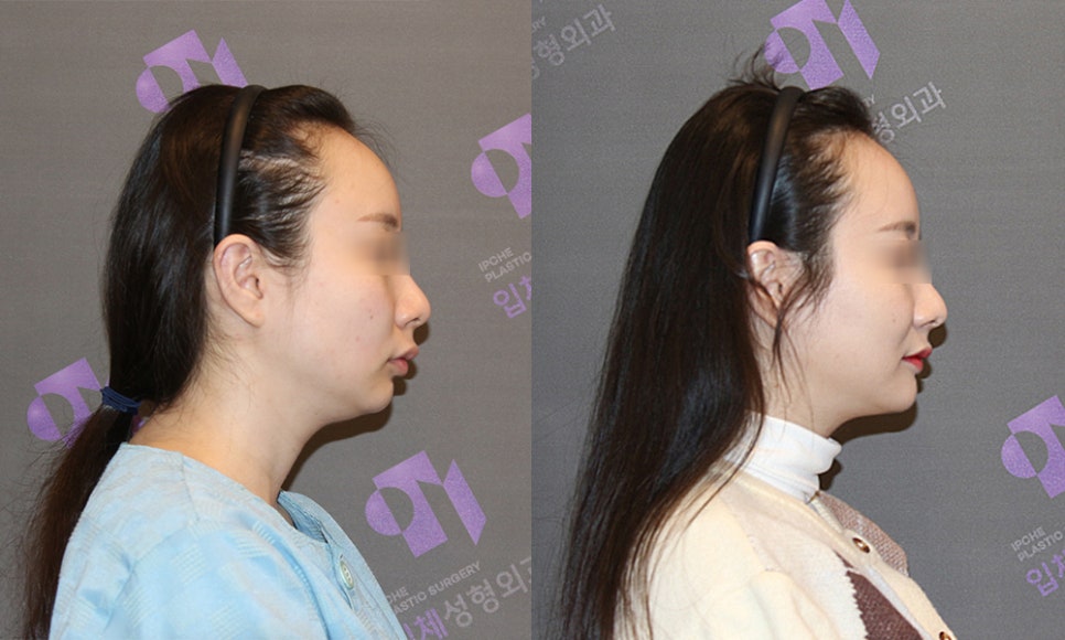 What Surgery Is Best for Correcting a Recessed Chin? The Limits of Chin Advancement Surgery and the Actual Results image 3