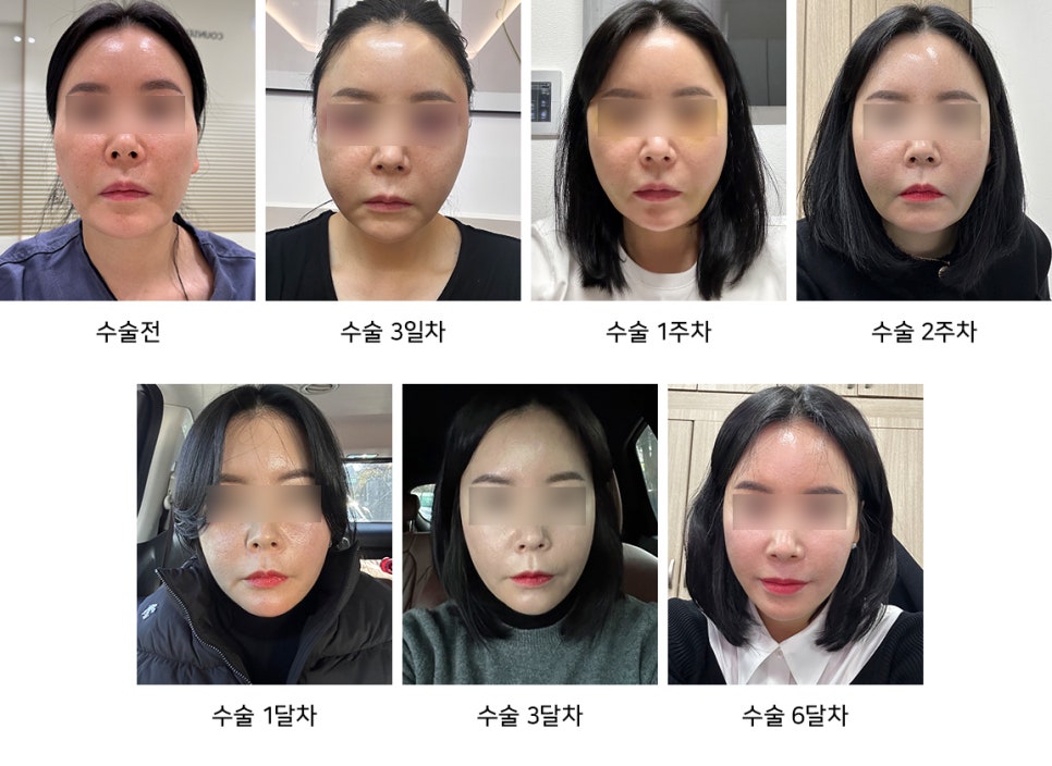 안면윤곽수술 50대에 받아도 될까요? 꼭 알아둬야 할 사항들 관련 이미지 10