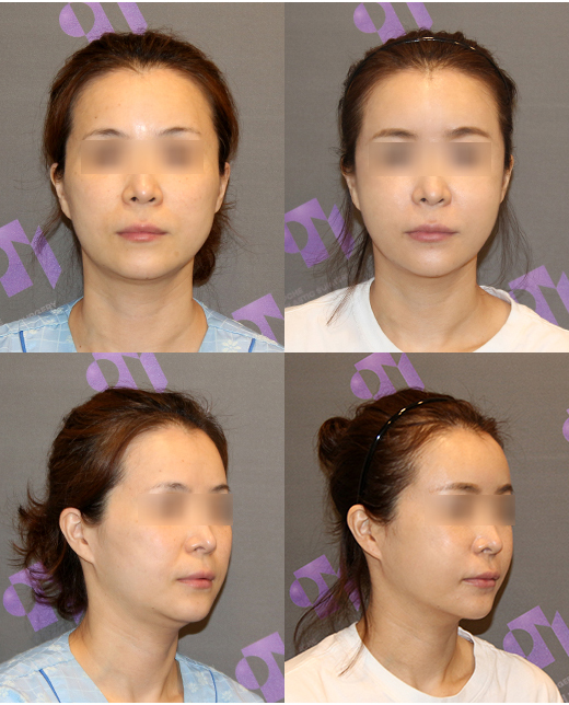 안면윤곽 수술과 같이 하면 좋은 수술 관련 이미지 2