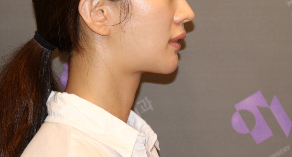 [Chin Surgery] Learning About Contouring Shave and T-Osteotomy with Real Patient Cases (2) image 12