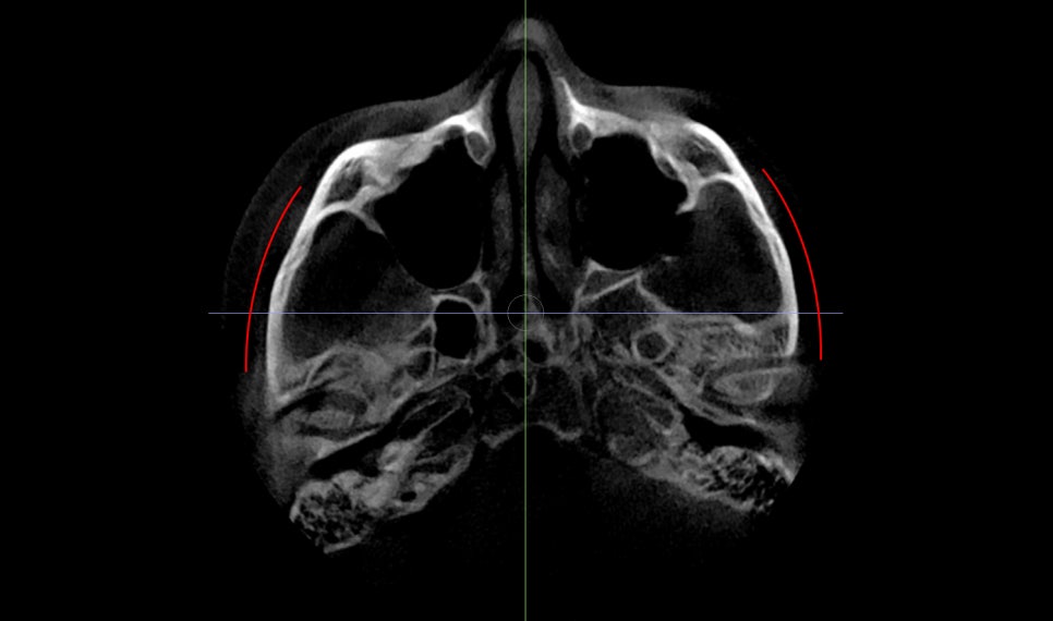Back Cheekbone Shaving? Osteotomy? Do You Really Need It? image 3