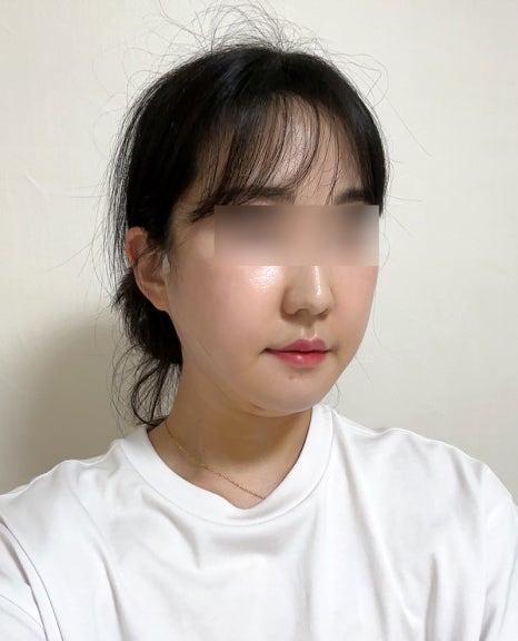 How Long Do Facial Contour Changes Continue After Facial Bone Contouring Surgery? (Day 1 to Day 365) — See With Photos image 5