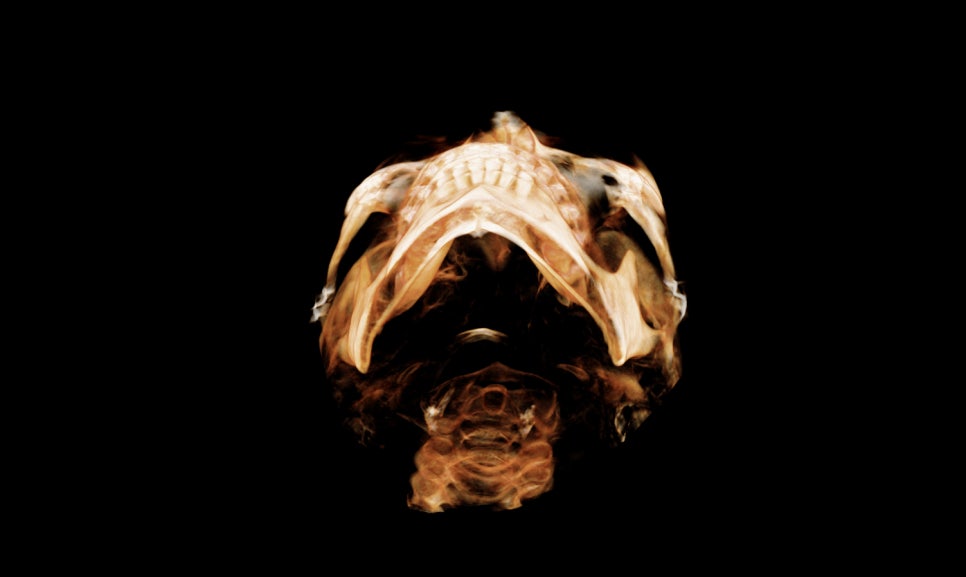 Why Are There So Many Methods for Cheekbone Surgery? A Look at Osteotomy Methods image 11
