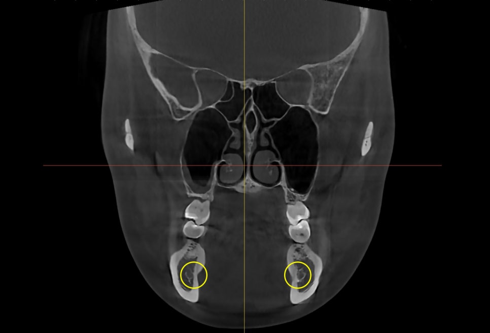 Square Jaw Surgery: The Difference Between Cortical Osteotomy and Lateral Cortical Shaving image 4