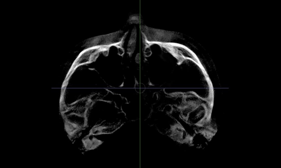 After cheekbone reduction surgery, is there still a back cheekbone left? Is there a solution? image 4