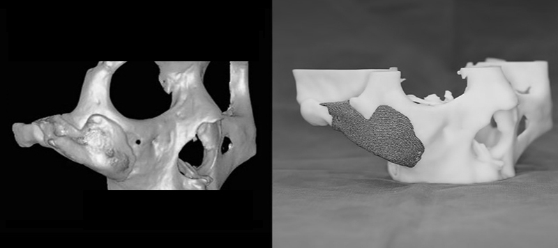 Can Overcorrection of the Cheekbones Be Reversed? image 1