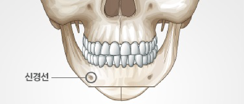 Is T-Osteotomy Better for Chin Surgery? - Explained by a Specialist image 2