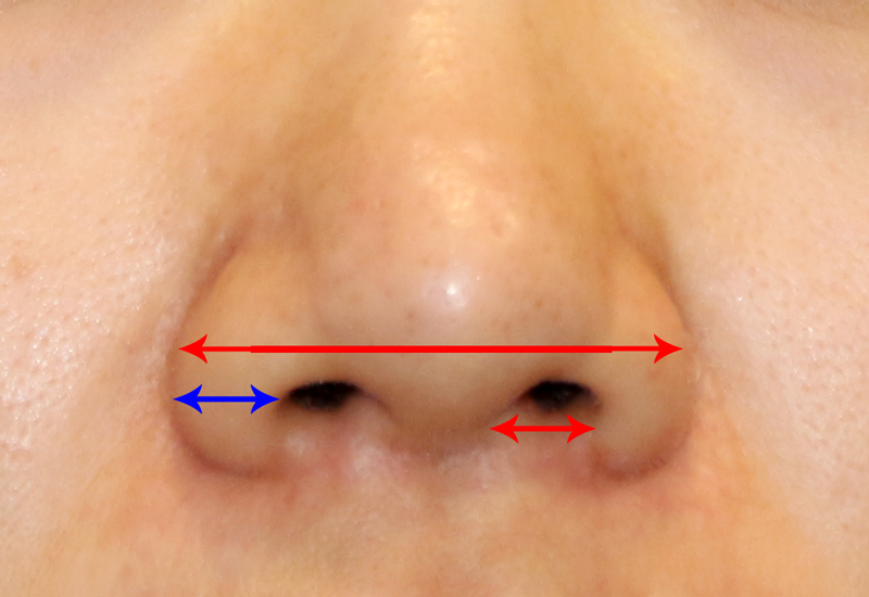 Is There a Nose Alar Reduction Surgery Without Scarring? (Looking at Before-and-After Photos) image 1