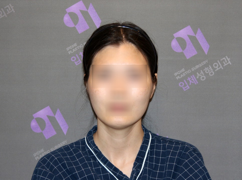 230도 입체 광대축소술로 재수술도 가능할까요? 관련 이미지 14