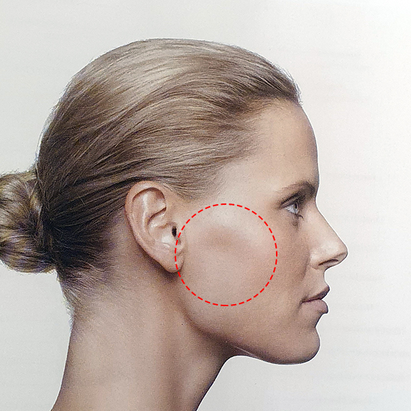 Sunken Cheeks!? It’s Not a Side Effect of Zygoma Surgery! image 2