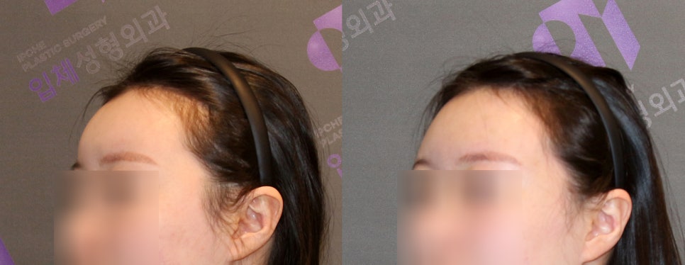 이마지방이식 제거 할 수 있을까요? 관련 이미지 5
