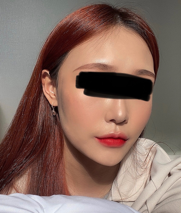 광대수술 후 이차각, 계단현상은 왜 생기는 걸까요? 관련 이미지 8