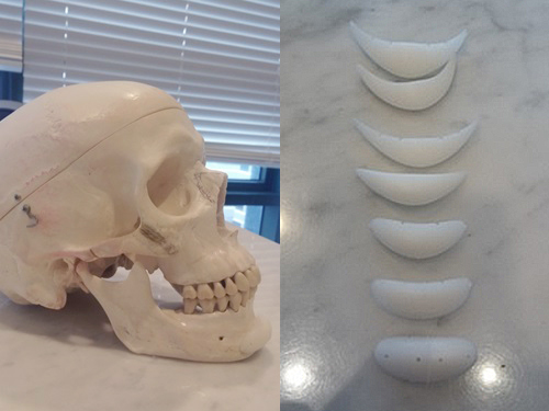Chin Implants and Chin Advancement Surgery: Real Surgical Cases and What to Know image 1