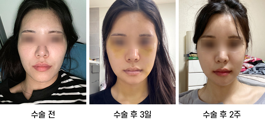 Do Not Confuse Facial Contouring Sagging with Swelling! image 3