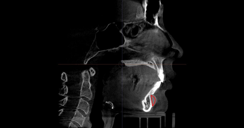 What Surgery Is Best for Correcting a Recessed Chin? The Limits of Chin Advancement Surgery and the Actual Results image 7