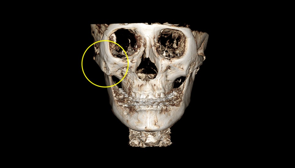 How Much Effect Does 230-Degree Three-Dimensional Zygomatic Reduction Have? image 4