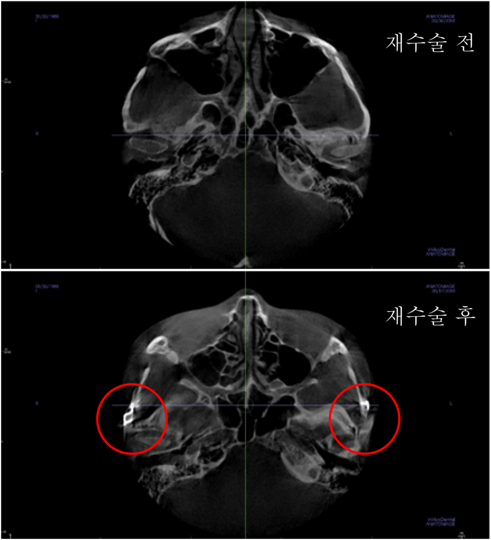 Cheek Sagging? Nonunion? Hollow Cheeks? A Complete Guide to 6 Side Effects of Zygoma Surgery image 6