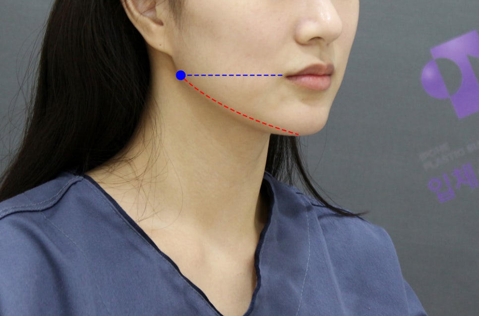 If There Is No Jaw Angle Below the Ears, Is It a “Dog Jaw”? What Is a Dog Jaw? image 9