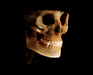 After Facial Contouring Surgery: Asymmetry, When Can Revision Surgery Be Performed? image 1