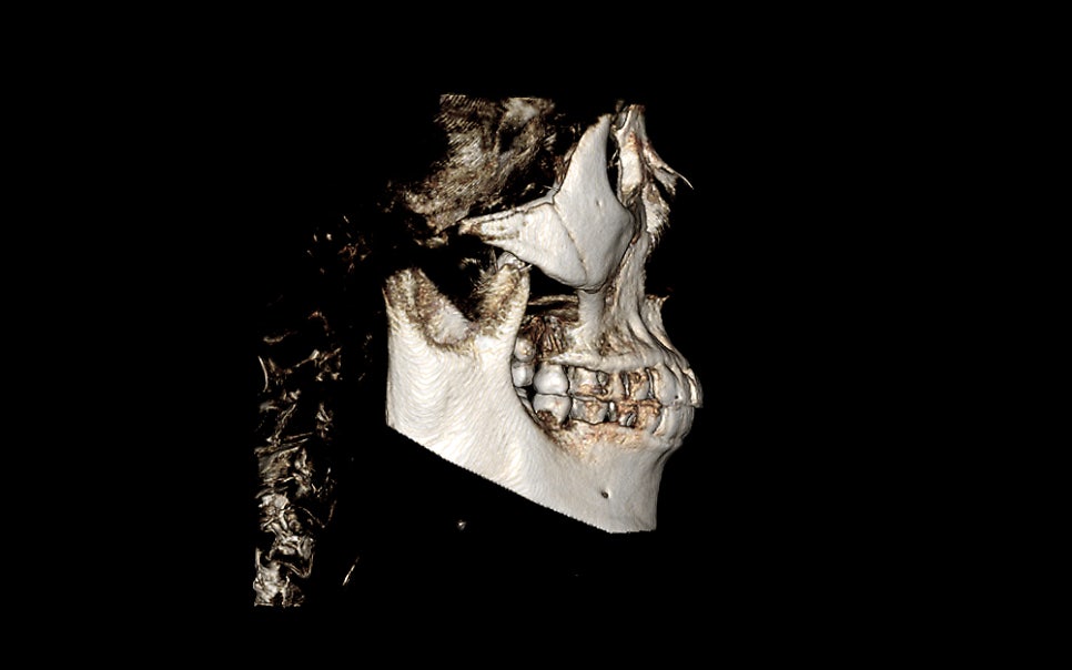 Consultation and Design Before Facial Contouring Surgery image 5