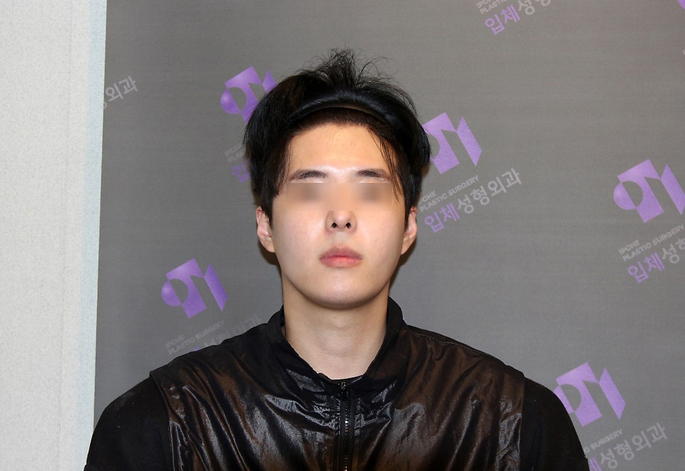 230도입체광대축소술로 재수술이 가능한 경우가 있을까요? 관련 이미지 6