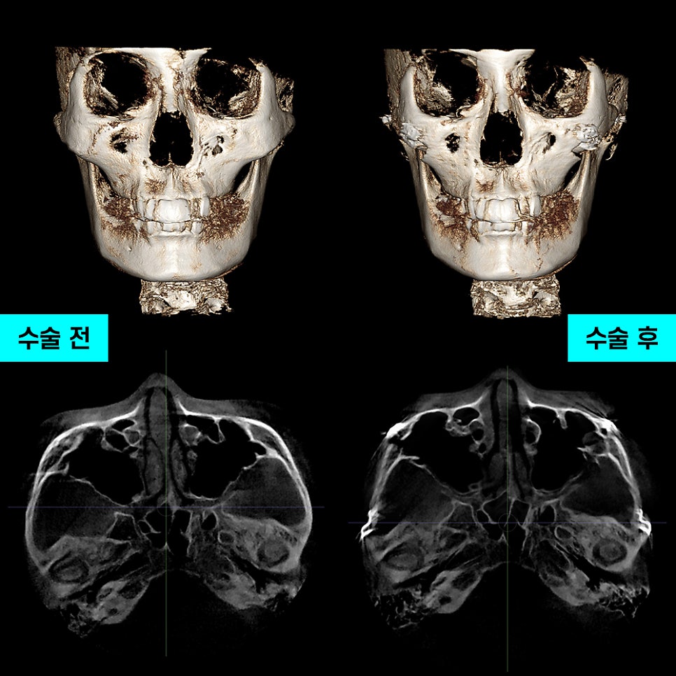 Zygoma Reduction Surgery: the Effectiveness and Selection Criteria of 230-Degree Zygoma vs. 3D Zygoma Surgery image 7