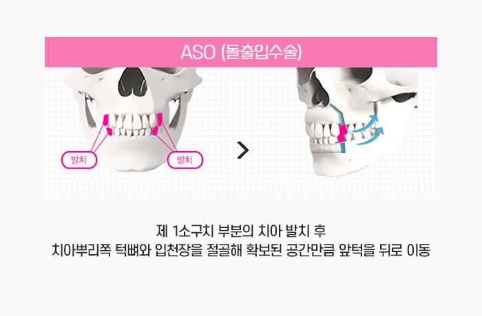 안면윤곽수술과 양악수술은 어떻게 다른가요? 관련 이미지 4