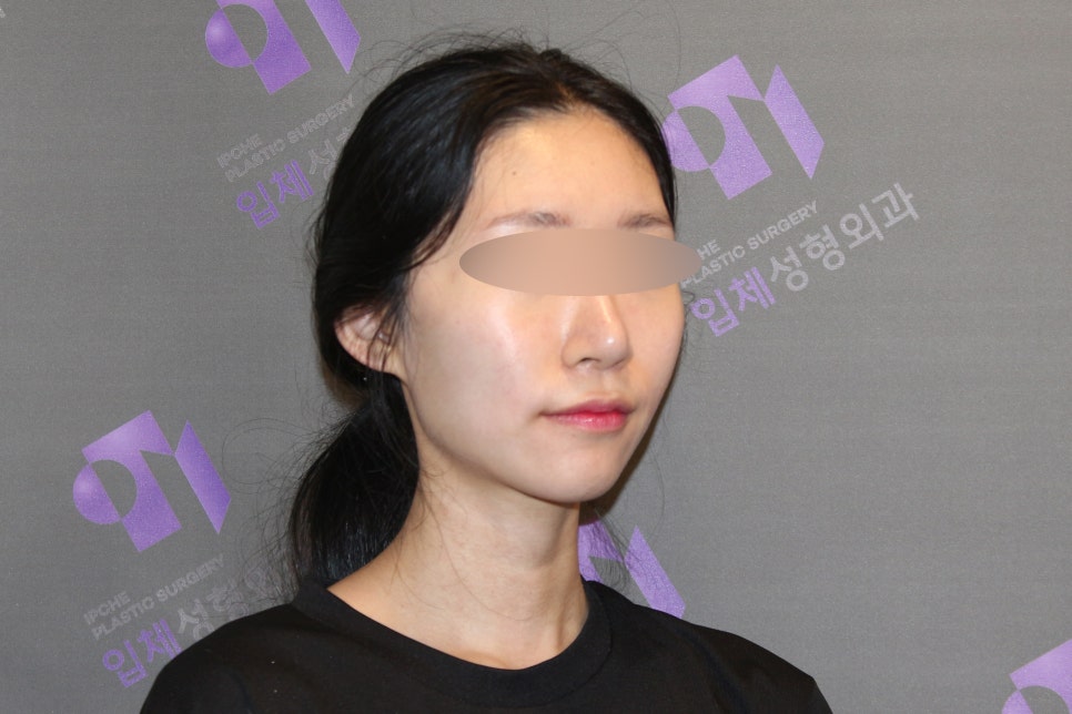 45-Degree Cheekbone Reduction Surgery Review, Let’s Look at Cases Together - Information from a Specialist image 6
