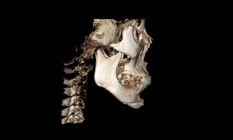 What Surgery Is Best for Correcting a Recessed Chin? The Limits of Chin Advancement Surgery and the Actual Results image 11