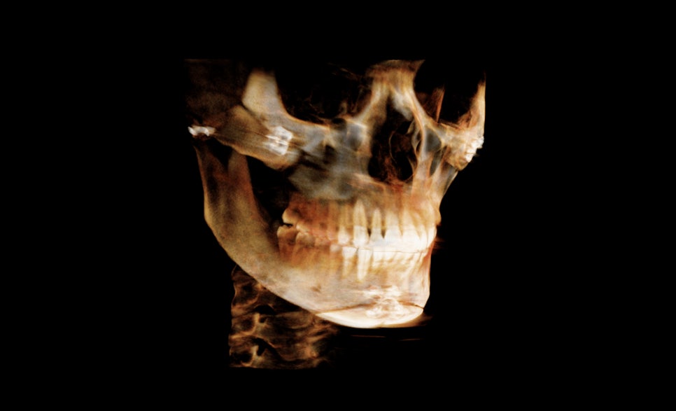 Is It Necessary to Remove the Fixation Pins After Facial Contouring Surgery? image 2
