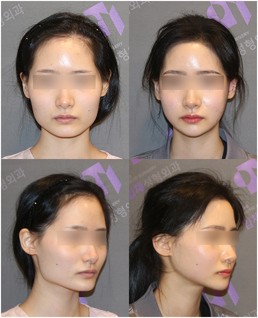 If the nerve line is low, can’t you have jaw angle surgery? Is there any way to make the front view slimmer? image 3