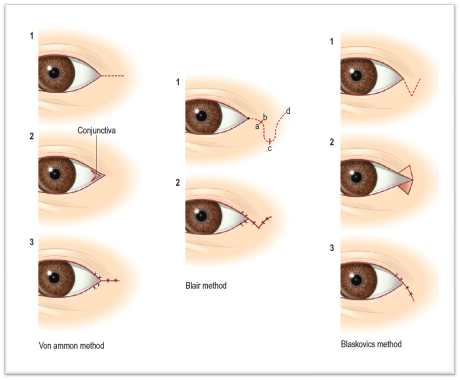 Surgery That Goes Well with Cheekbone Surgery, Part 1: Lateral and Lower Canthoplasty image 2