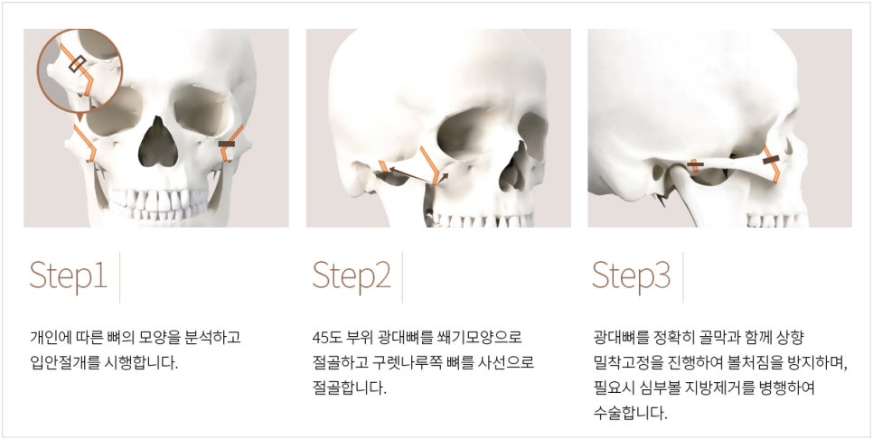 230도입체광대가 3D광대축소술보다 더 좋은가요? 관련 이미지 1