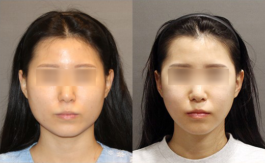 사각턱수술, 피질절골과 외측피질쉐이빙의 차이 관련 이미지 14