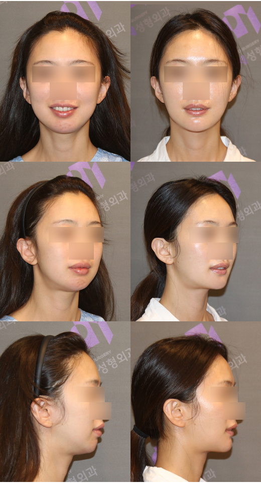 Facial Contouring Surgery image 7