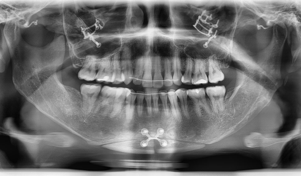 After Facial Contouring Surgery: Asymmetry, When Can Revision Surgery Be Performed? image 10