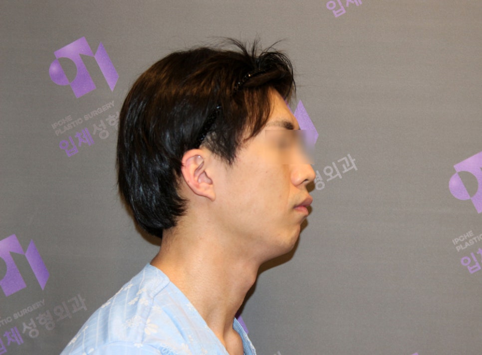 What Surgery Is Best for Correcting a Short Chin or Recessed Chin? The Limits of Chin Surgery and the Actual Results image 10