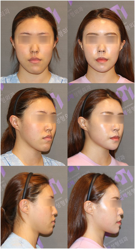 [Chin Surgery] Learning About Contouring Shave and T-Osteotomy with Real Patient Cases (2) image 5
