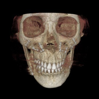 Which Surgery Do I Need: Contouring Surgery or Double-Jaw Surgery? image 6