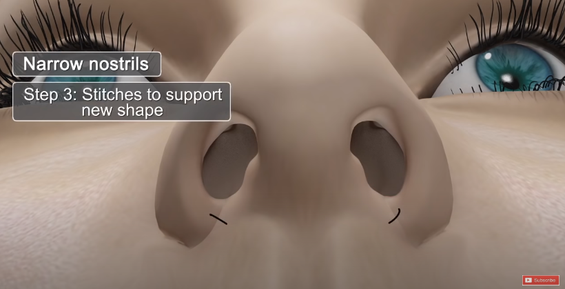 Is There a Nose Alar Reduction Surgery Without Scarring? (Looking at Before-and-After Photos) image 4